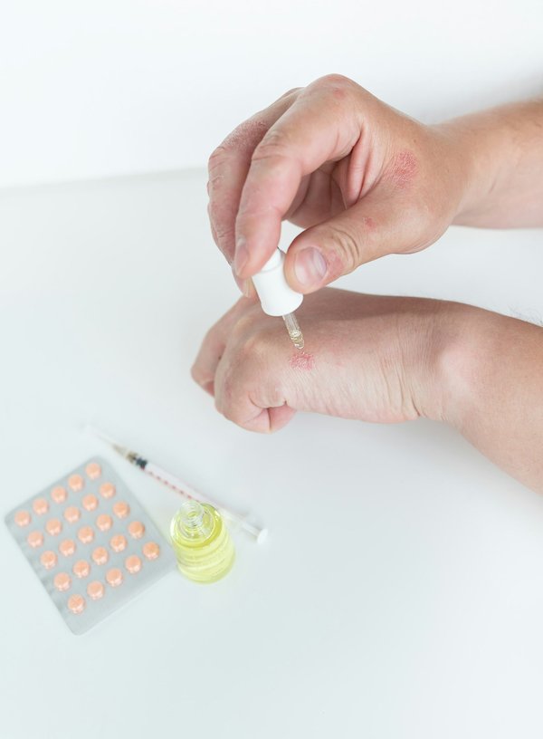 Eczéma bulleux et dishydrose : symptômes et solutions pratiques